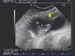 Sexul copilului la ultrasunete, determinarea sexului prin ultrasunete, erori uzi în determinarea sexului