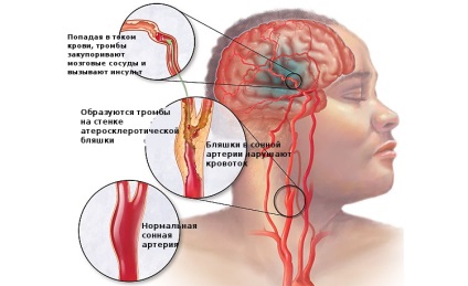 Consecințele accidentului vascular cerebral ischemic - simptome și tratamentul complicațiilor