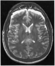 Deteriorarea creierului - leziuni craniocerebrale la copii