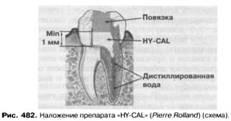 Pregătiri pentru umplerea temporară a canalului radicular