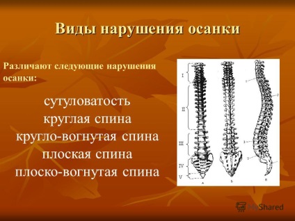 Prezentare pe tema scolioză - aceasta este fixabilă