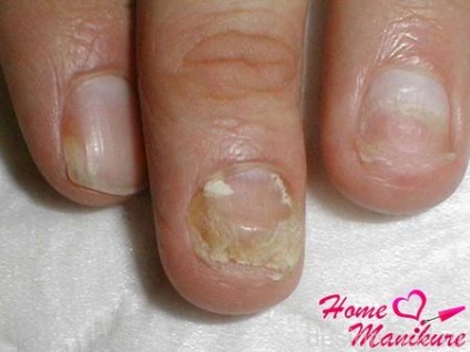 Причини і способи лікування онихолизиса нігтів, дизайн нігтів