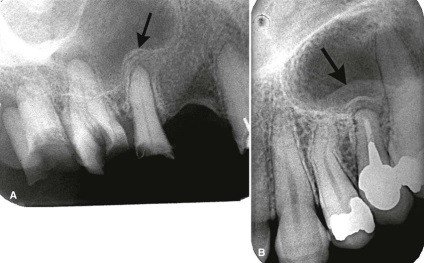 Az okok a pofa a fogágy - diagnózis és paradentózisnál állkapocs gyermekeknél és felnőtteknél