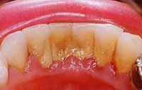 Cauzele bolilor dentare - stomatologie din Moscova