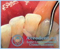 Cauzele bolilor dentare - stomatologie din Moscova