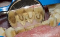 Причини стоматологічних захворювань - стоматологія москви