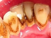 Причини стоматологічних захворювань - стоматологія москви