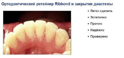 Aplicați panglica de panglică (ribbond) în instruirea stomatologică cu video