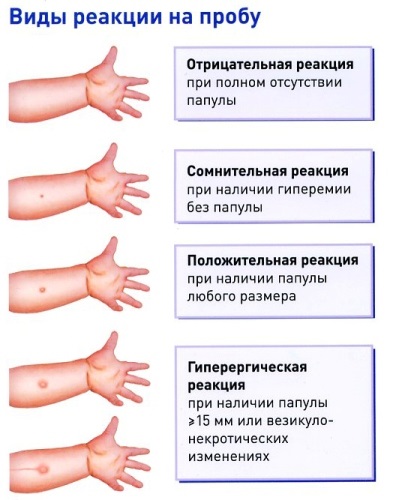 щеплення манту