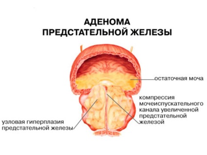 Профілактика аденоми передміхурової залози (простати) у чоловіків дієтою, ліками і народними