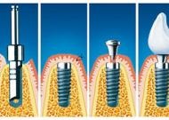 Proteză, Ukrdental primul server dentar ucrainean