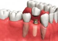 Proteză, Ukrdental primul server dentar ucrainean