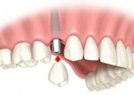 Proteză, Ukrdental primul server dentar ucrainean