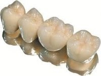 Протезування зубів - Стоматологія солнцево парк
