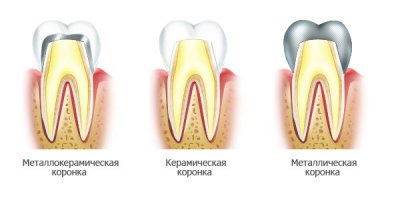 Protetica dentară - stomatologie