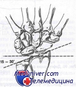 Fracturi extensoare ale oaselor antebratului de coliziune