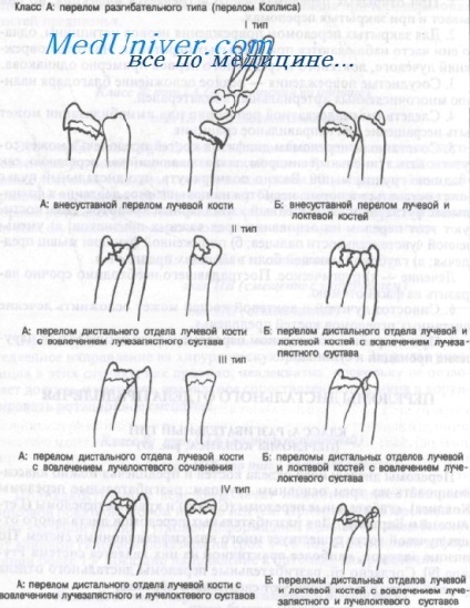 Fracturi extensoare ale oaselor antebratului de coliziune