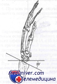 Розгинальні переломи кісток передпліччя Колліса