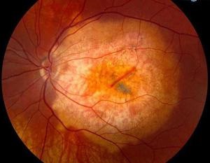 Retinopatia, ce este, tipurile, simptomele și tratamentul