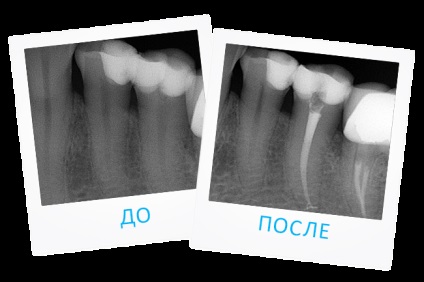 Pulpită retrograda simptome, cauze, tratament, fotografii, prețurile și costul tratamentului retrograd