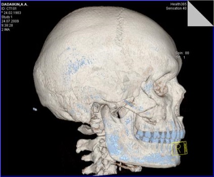 Rezultatele tratamentului chirurgical al victimelor cu leziuni ale osului zygomatic