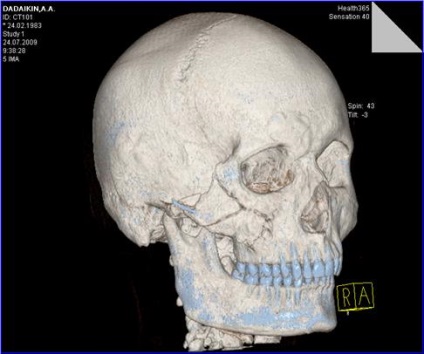 Rezultatele tratamentului chirurgical al victimelor cu leziuni ale osului zygomatic