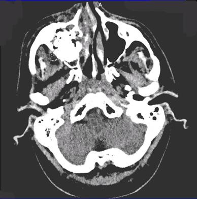 Rezultatele tratamentului chirurgical al victimelor cu leziuni ale osului zygomatic