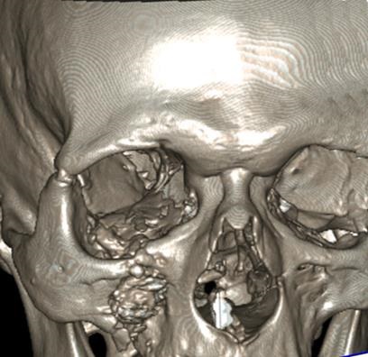 Rezultatele tratamentului chirurgical al victimelor cu leziuni ale osului zygomatic