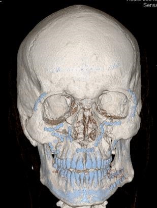 Rezultatele tratamentului chirurgical al victimelor cu leziuni ale osului zygomatic