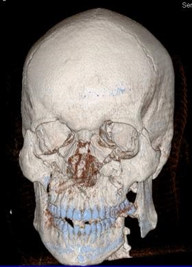 Rezultatele tratamentului chirurgical al victimelor cu leziuni ale osului zygomatic