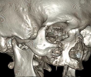 Rezultatele tratamentului chirurgical al victimelor cu leziuni ale osului zygomatic