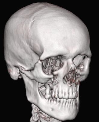 Rezultatele tratamentului chirurgical al victimelor cu leziuni ale osului zygomatic