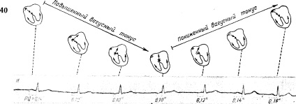 Ritmul sinusalului coronarian (sinus venosus coronarius)