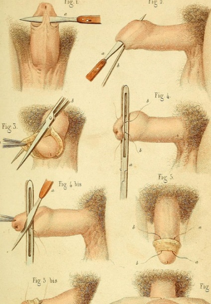 Рубцевий фімоз у хлопчиків, фото, симптоми і лікування, prostatit-med