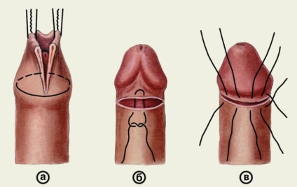 Fimoza cutanată la băieți, fotografii, simptome și tratament, prostatit-med