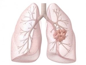 Simptomele, diagnosticul și tratamentul cancerului pulmonar cu celule scuamoase