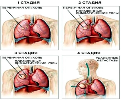 Simptomele, diagnosticul și tratamentul cancerului pulmonar cu celule scuamoase