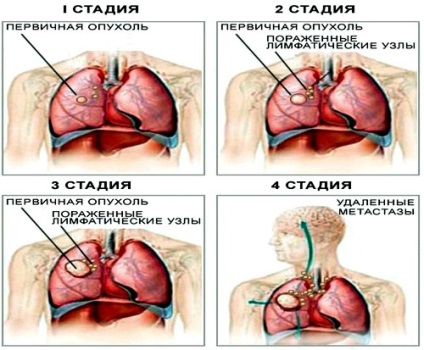 Симптоми, діагностика та лікування плоскоклітинного раку легенів