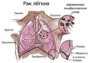 Симптоми, діагностика та лікування плоскоклітинного раку легенів