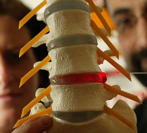Modern kezelési módszerek sérvek a nyaki gerinc