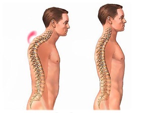 Spondiloza simptomelor și tratamentului coloanei vertebrale cervicale