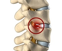 Spondylarthrosis mi ez, fájdalom kezelésére deformáló ízületi spondiloarthritisz