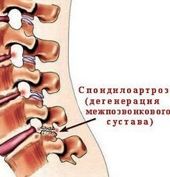 Spondylarthrosis mi ez, fájdalom kezelésére deformáló ízületi spondiloarthritisz