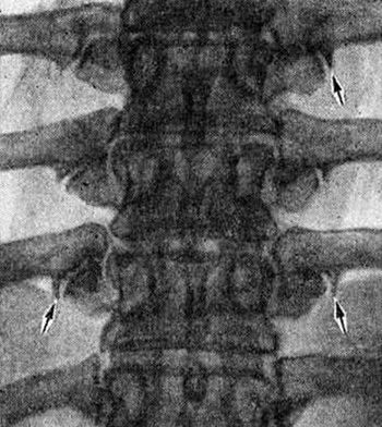 Spondylarthrosis mi ez, fájdalom kezelésére deformáló ízületi spondiloarthritisz