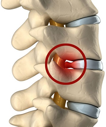 Spondylarthrosis mi ez, fájdalom kezelésére deformáló ízületi spondiloarthritisz