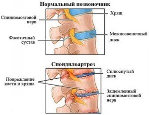 Спондилоартроз шийного відділу хребта симптоми, лікування та ін при різних формах