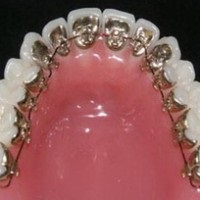 Вартість лінгвальних брекетів в Казані, лікування зубів