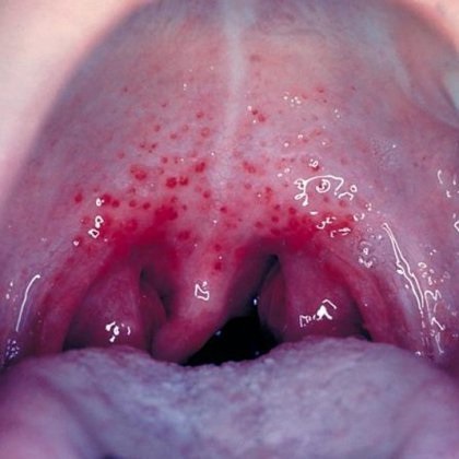 Streptococul în gât este un pericol care trebuie eliminat