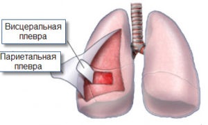 Simptomele și tratamentul pleureziei uscate, diferența de pleurezie exudativă