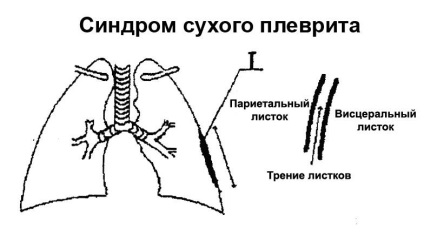 Simptomele și tratamentul pleureziei uscate, diferența de pleurezie exudativă